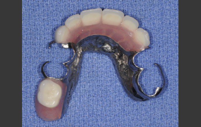 Upper And Lower Removable Partial Dentures Without Implants Dental