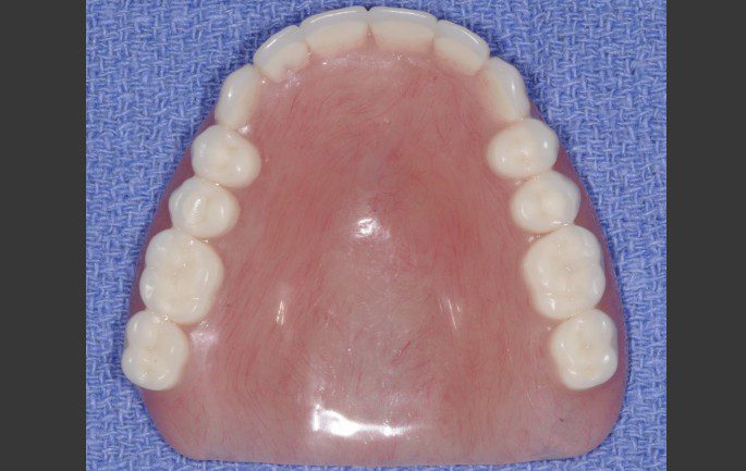 Complete Upper Denture Lower Implant Overdenture 2 Implants Female