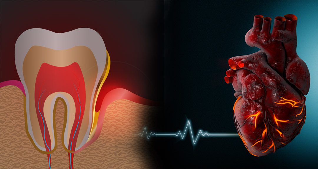 How Oral Bacteria Can Trigger Heart Disease - Dental Implant Center