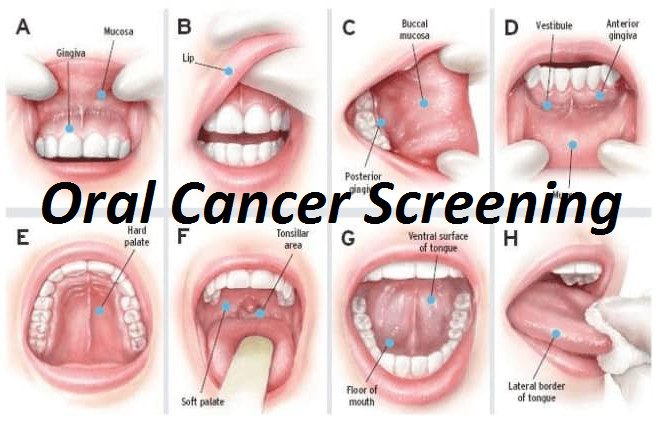 WARNING SIGNS OF ORAL CANCER - Dental Implant Center
