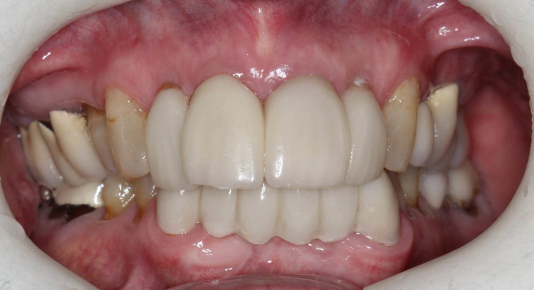 Lips retracted, frontal view