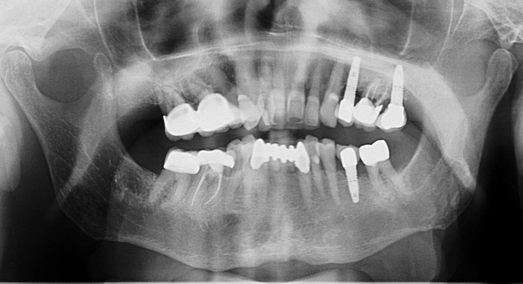 Pre-op panoramic x-ray.