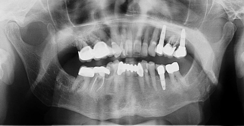 Pre-op panoramic x-ray.