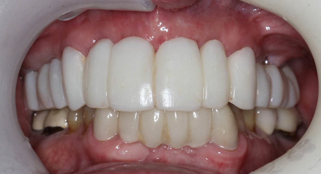 Stage one, fixed temporaries. By saving and using strategic teeth we can transition from teeth – teeth with implants – just implants. Non-strategic teeth are then extracted, implants placed and an acrylic fixed temporary fabricated, modified and cemented. This temporary only rests on teeth. Note how much improvement has already occurred!