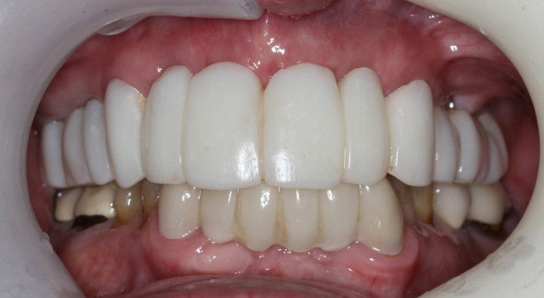 Stage one, fixed temporaries. By saving and using strategic teeth we can transition from teeth – teeth with implants – just implants. Non-strategic teeth are then extracted, implants placed and an acrylic fixed temporary fabricated, modified and cemented. This temporary only rests on teeth. Note how much improvement has already occurred!