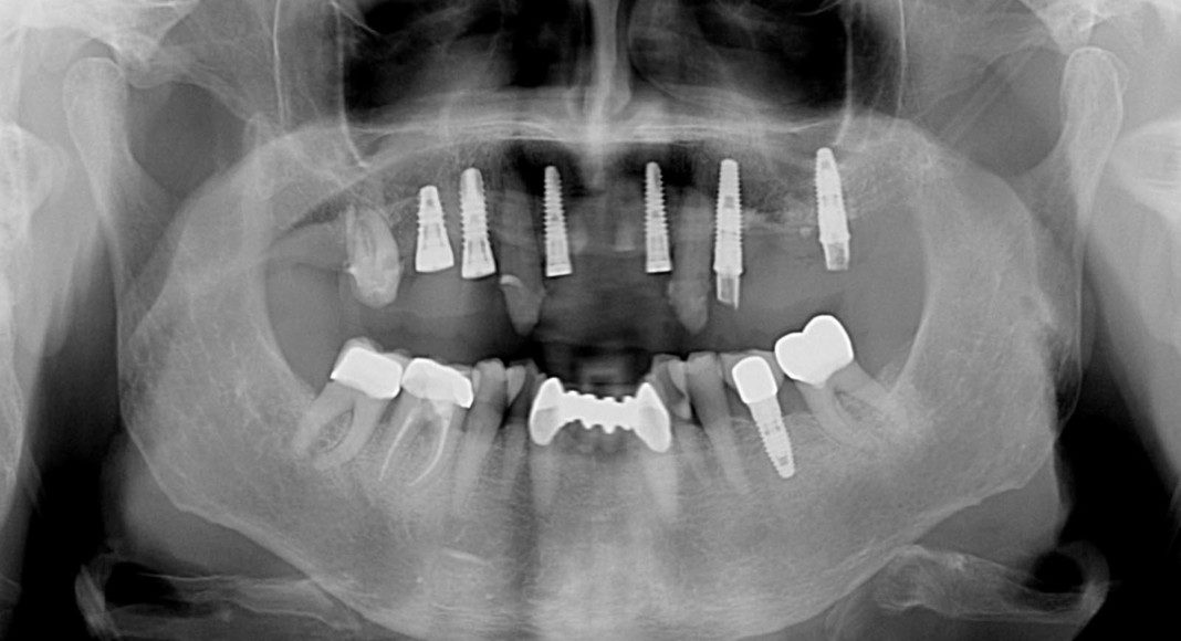 Progress panoramic x-ray. This x-ray really tells the story, visually. Notice the presence of teeth and implants. When immediate implant stability is not high enough to support the temporary bridge, we use some teeth as abutments (resting spots) for the temporary bridge. This prevents the patient from ever having to wear a temporary denture. This transitional phase allows the patient to be very comfortable while the implants are gaining stability (microscopic adhesion of the implant to the bone) and the temporary bridge is cemented to the strategic teeth.