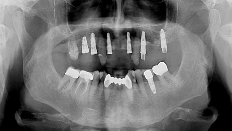 Progress panoramic x-ray. This x-ray really tells the story, visually. Notice the presence of teeth and implants. When immediate implant stability is not high enough to support the temporary bridge, we use some teeth as abutments (resting spots) for the temporary bridge. This prevents the patient from ever having to wear a temporary denture. This transitional phase allows the patient to be very comfortable while the implants are gaining stability (microscopic adhesion of the implant to the bone) and the temporary bridge is cemented to the strategic teeth.