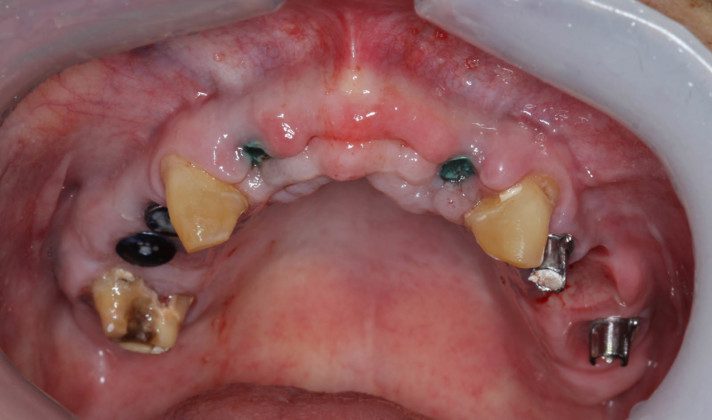 2 months later, teeth and implants after temporary is removed. The implants are now ready to serve as the anchors for the temporary bridge. At this second surgical appointment the strategic teeth are extracted, additional implants placed (if necessary) and the temporary bridge converted to the implants.