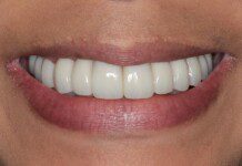 Full Mouth Implant Restoration