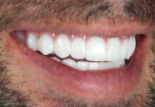 Implant Overdenture
