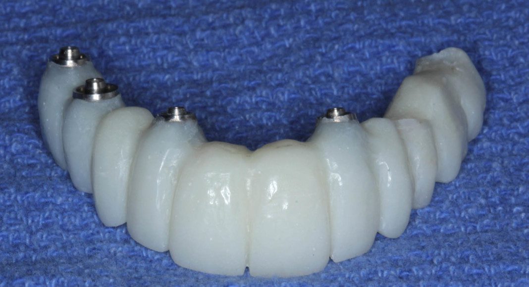 Frontal view of the converted temporary bridge (converted from all teeth supported to all implant supported). The titanium tops are the cylinders that connect the bridge to the implants.