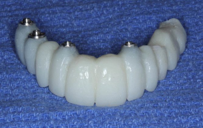 Frontal view of the converted temporary bridge (converted from all teeth supported to all implant supported). The titanium tops are the cylinders that connect the bridge to the implants.