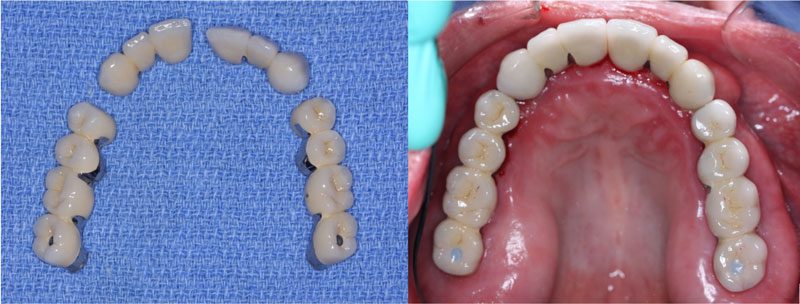 Alternatives to All-On-4, Bridges on Implants