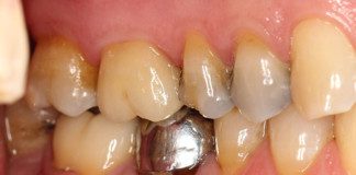 Single back tooth crown on right molar