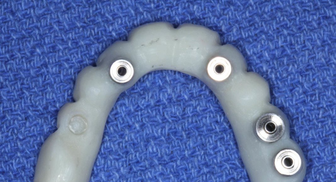Tissue-view of the converted temporary bridge (converted from all teeth supported to all implant supported). The titanium tops are the cylinders that connect the bridge to the implants.