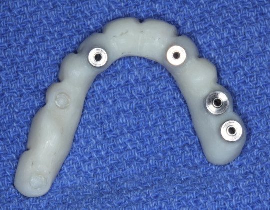 Tissue-view of the converted temporary bridge (converted from all teeth supported to all implant supported). The titanium tops are the cylinders that connect the bridge to the implants.