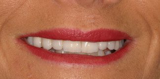 Front Bridge on Teeth (Female)
