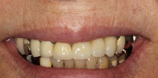 Fractured Tooth, Left, 3-Unit Front Bridge (Female)
