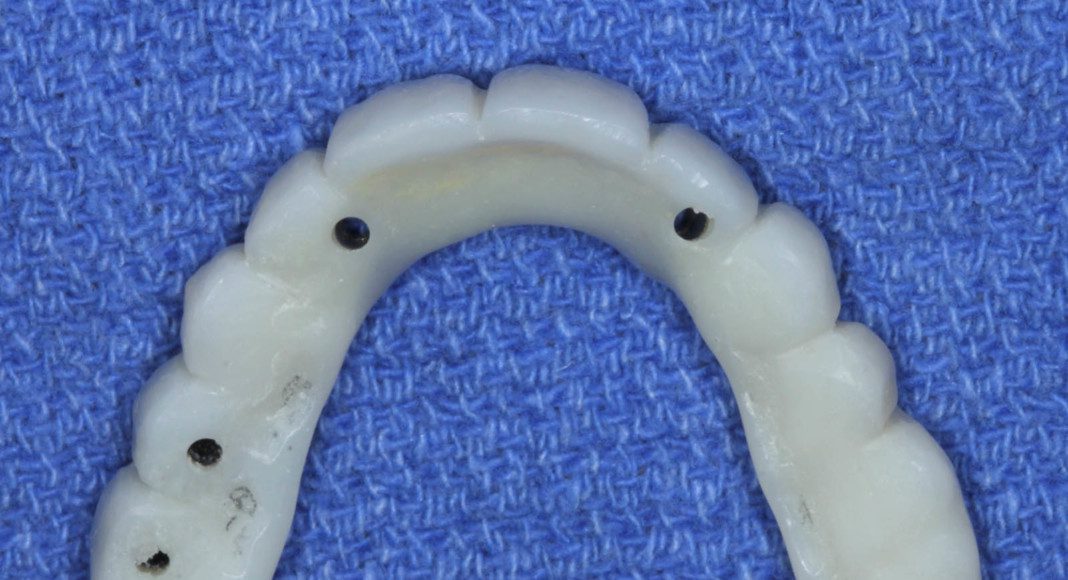 Occlusal view of the implant temporary bridge. The holes are where the prosthetic screws will pass through to secure the bridge to the implants.