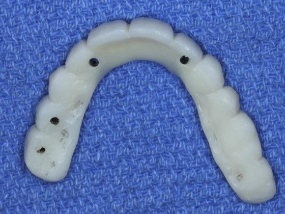 Occlusal view of the implant temporary bridge. The holes are where the prosthetic screws will pass through to secure the bridge to the implants.