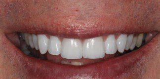 Smile with beautiful front porcelain crowns