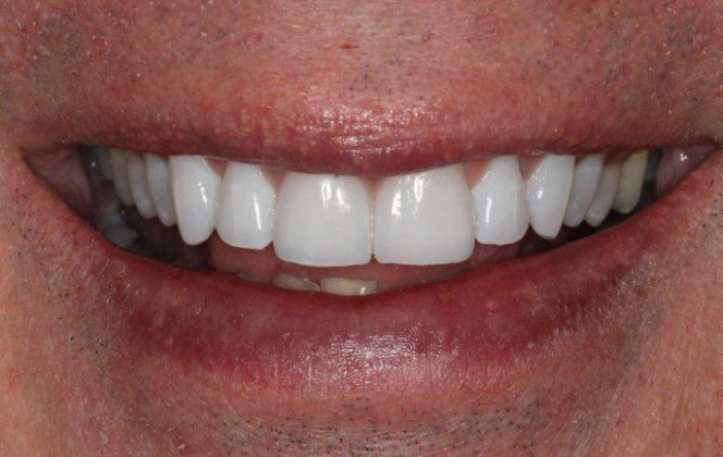 Smile with beautiful front porcelain crowns