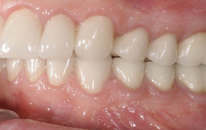 All ceramic crowns