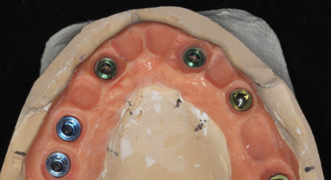 Occlusal view after 2 months. The final impression is made. This is the master cast of the implants and simulated gum tissue ready for the final zirconia bridge.