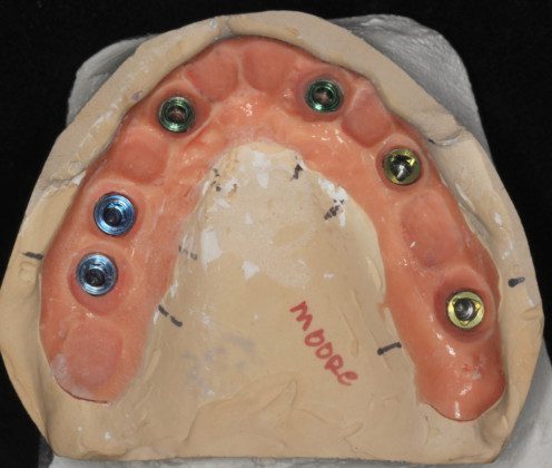 Occlusal view after 2 months. The final impression is made. This is the master cast of the implants and simulated gum tissue ready for the final zirconia bridge.