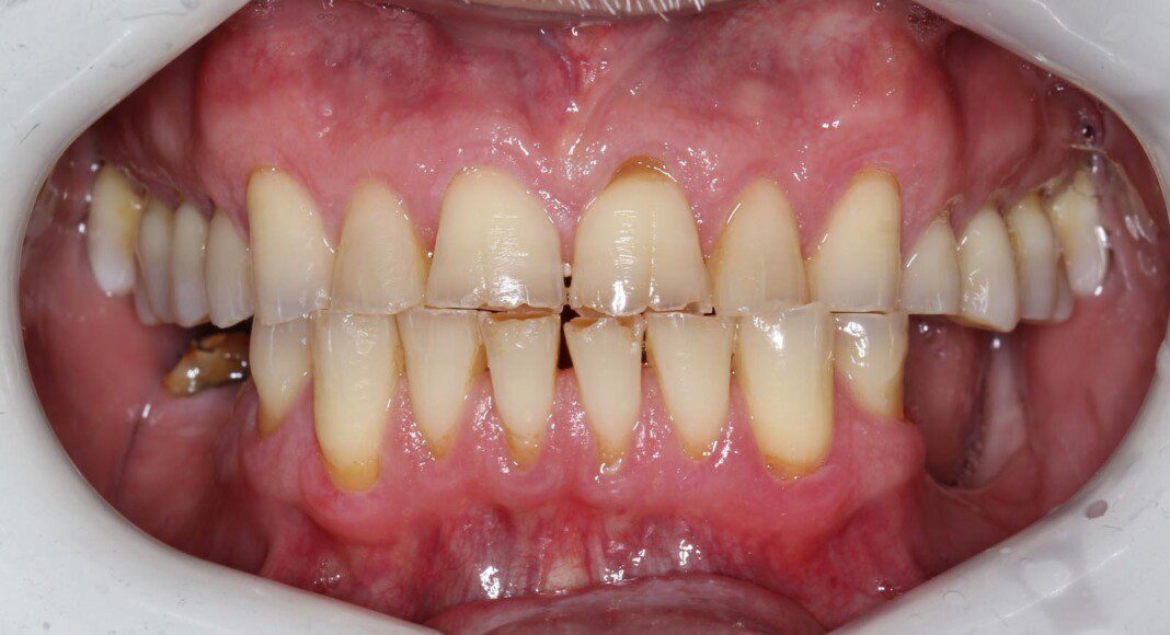 Lips retracted – frontal.