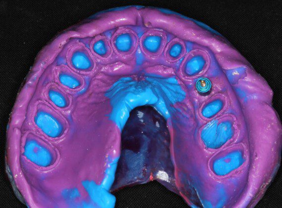 The most important part of any treatment for crowns or bridges is the FINAL IMPRESSION. For longevity of the crowns, it must have 100% of the margins of each tooth, clear and present. This is why most crowns and bridges fail on teeth… the dentist does not or cannot make an accurate final impression.