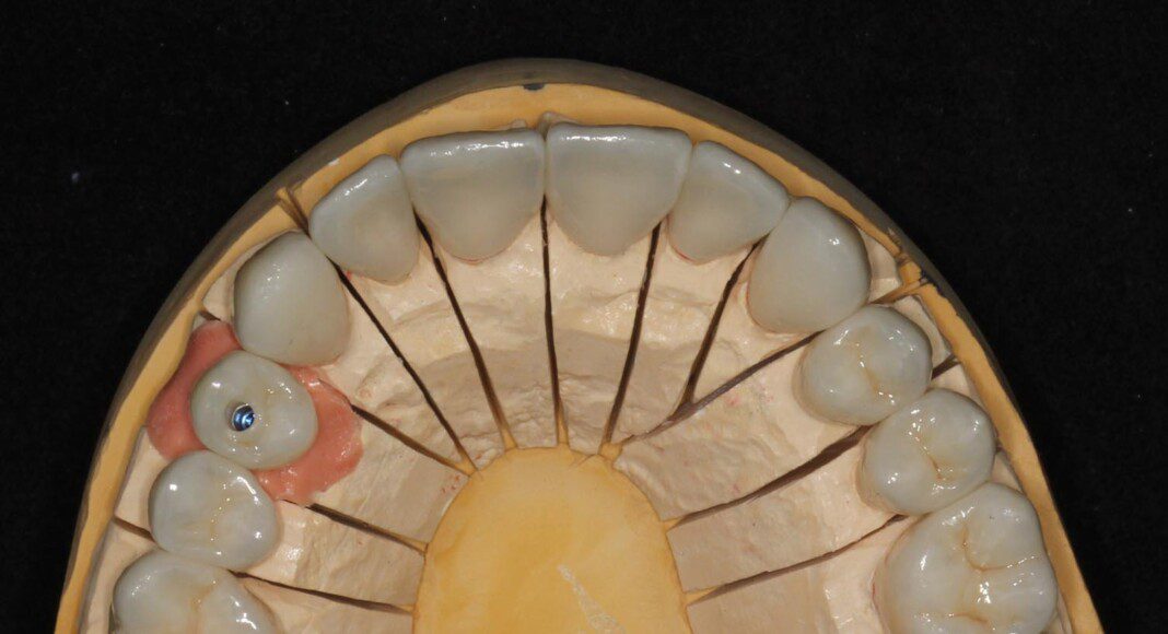 The crowns on the master cast (occlusal view).