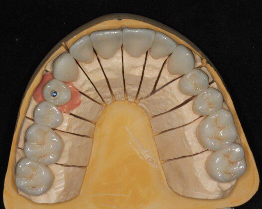 The crowns on the master cast (occlusal view).