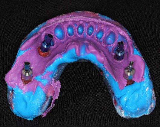 Lower final impression with posterior implants.