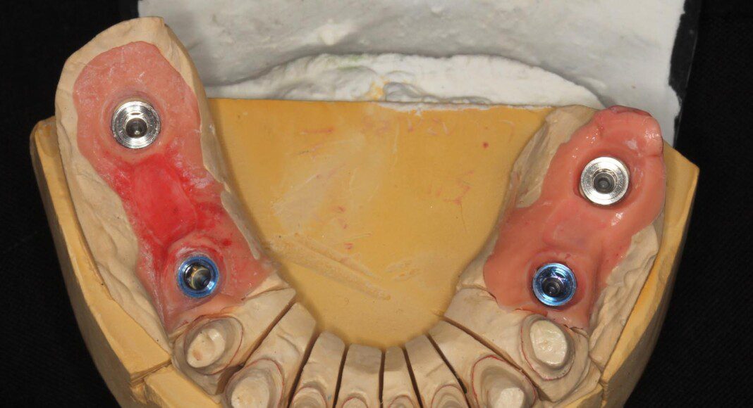 From the final impression, a master cast is fabricated. This cast will be used to make proper fitting crowns on the teeth and the implant bridges.