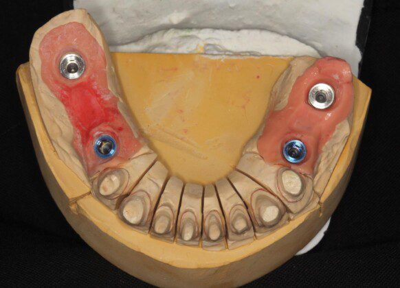 From the final impression, a master cast is fabricated. This cast will be used to make proper fitting crowns on the teeth and the implant bridges.