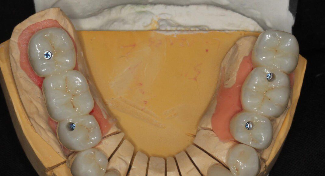 The crowns and implant bridges on the master cast (occlusal view).