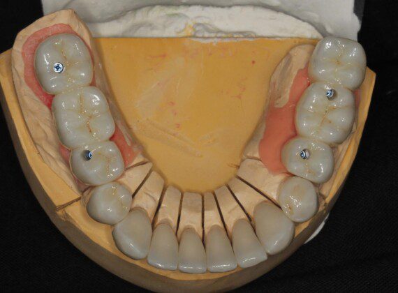 The crowns and implant bridges on the master cast (occlusal view).