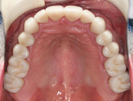 Upper crowns in place (occlusal view).