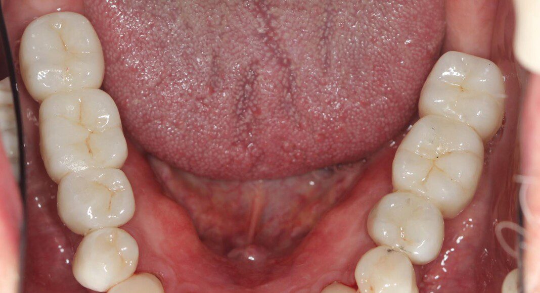 Lower crowns and implant bridges in place (occlusal view).