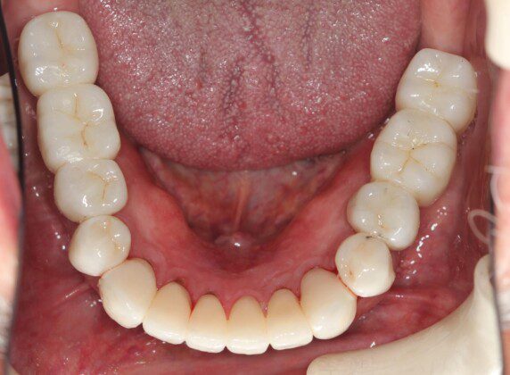 Lower crowns and implant bridges in place (occlusal view).