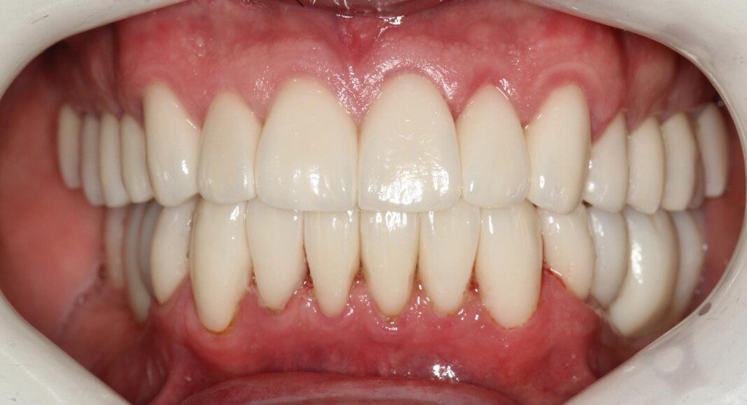 Crowns and implant bridges in place (frontal view).