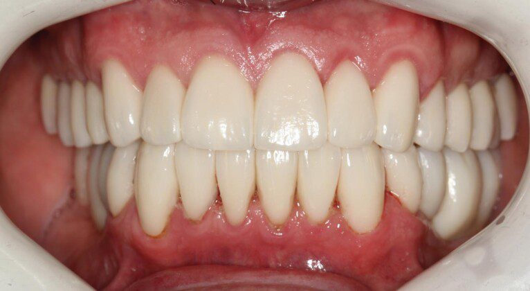 Crowns and implant bridges in place (frontal view).