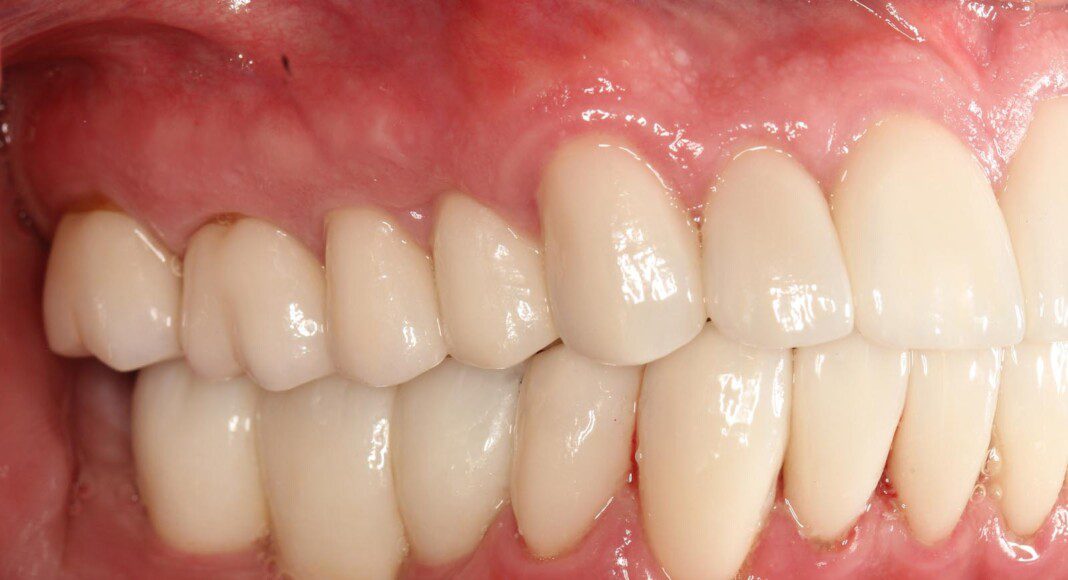 Crowns and implant bridges in place (right lateral view).