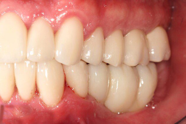 Crowns and implant bridges in place (left lateral view).