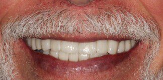Full Mouth Porcelain Crowns – Grinder – Staged (Male) Post-treatment close-up smile.