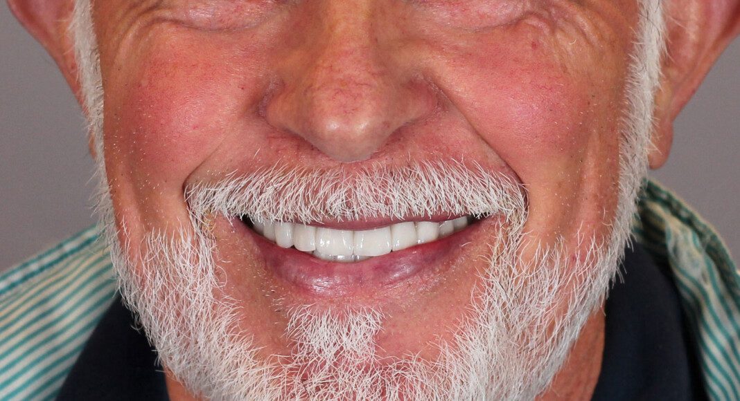 Post treatment, full face smile.