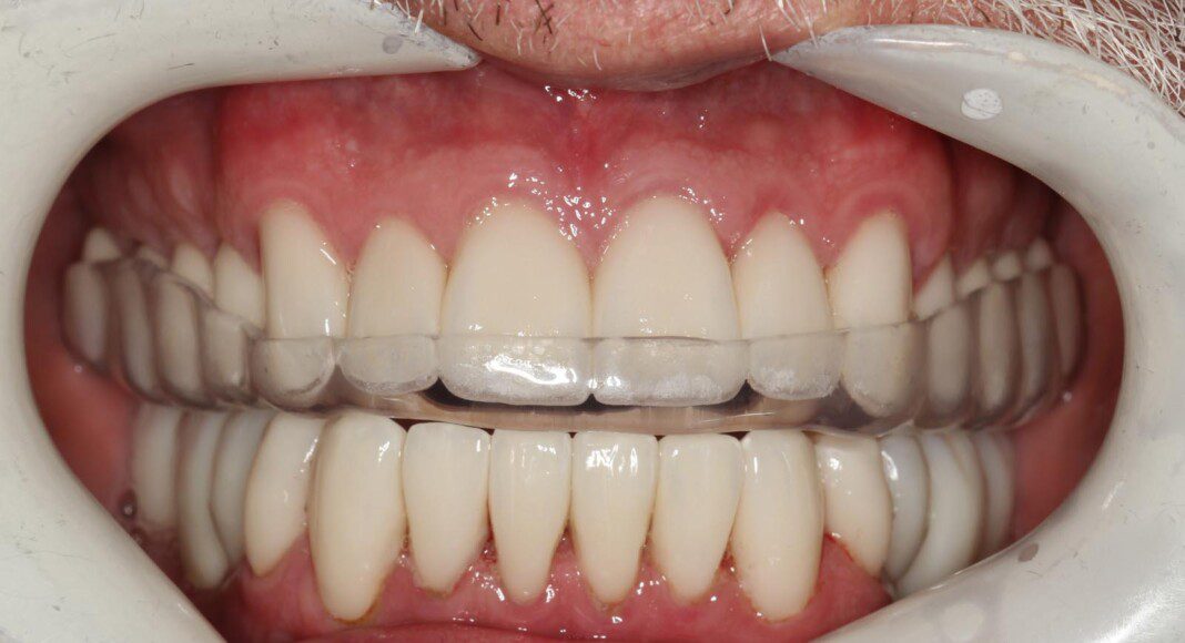 Nightguard (Occlusal guard) protects the patients investment. These guards are worn at night when the majority of grinding occurs.