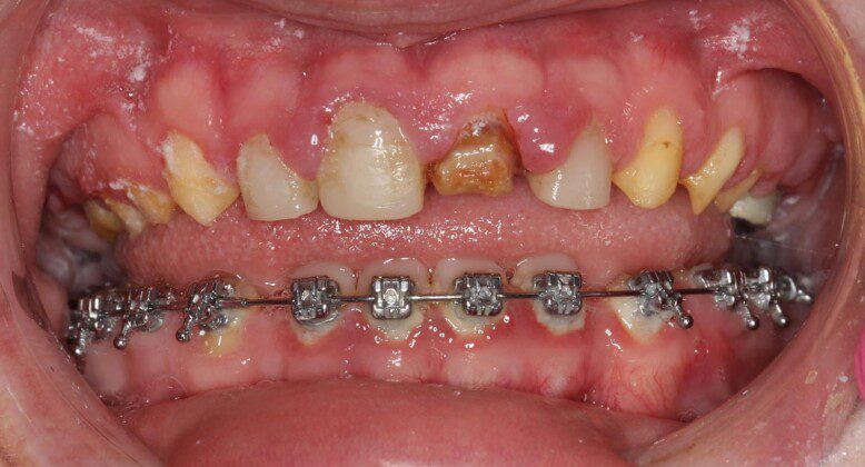 Braces are removed on the day of Prosthetic treatment.
