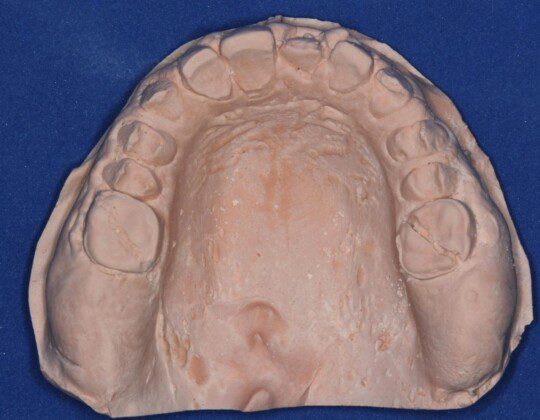 Pre-op cast (occlusal view). Preliminary impressions are made to begin the reconstructive process.
